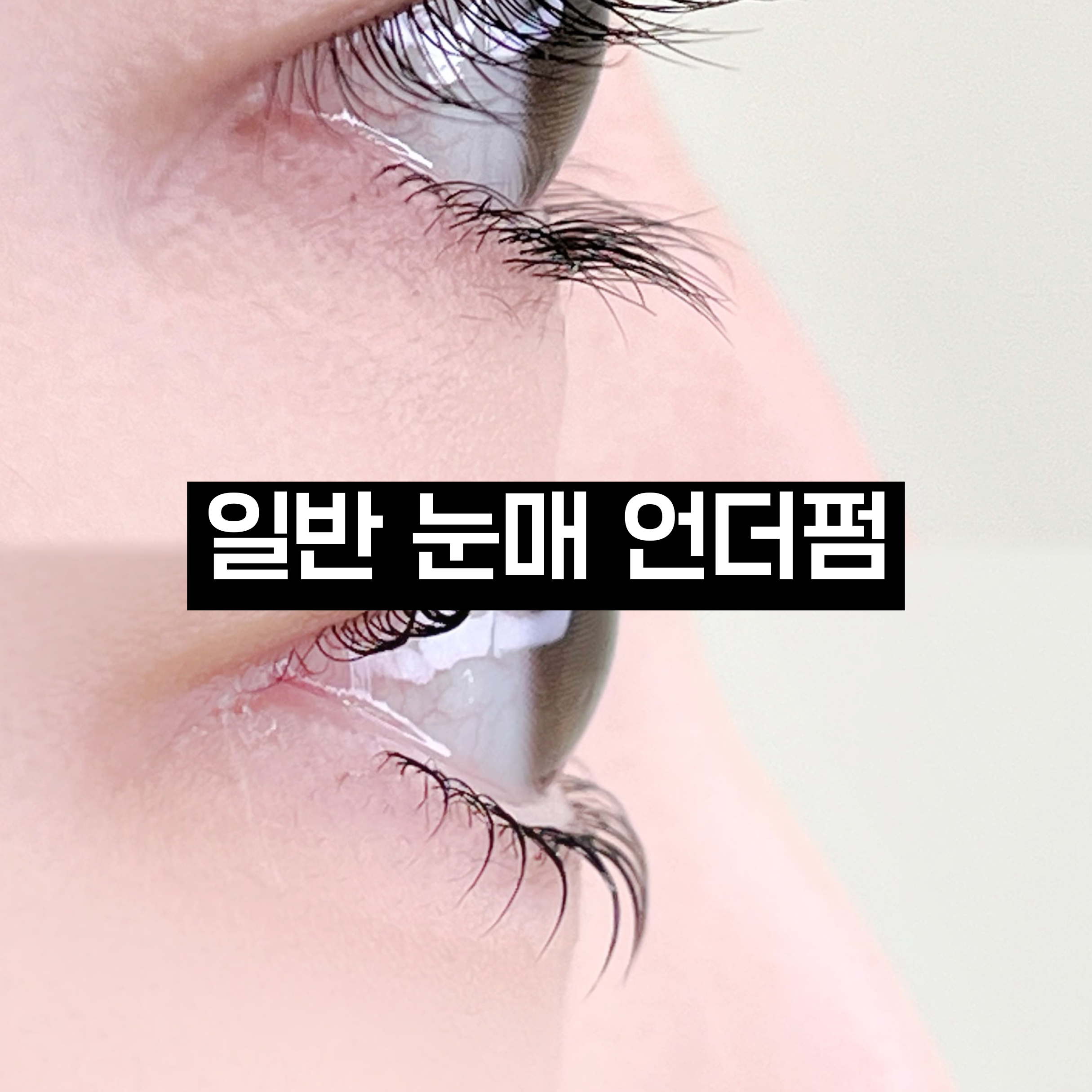 언더펌 시술 결과 1